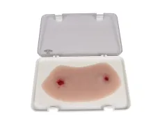 Wundmoulage Schuss Sprunggelenk