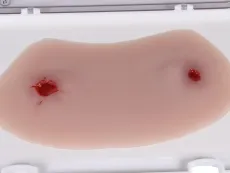 Wundmoulage Schuss Sprunggelenk