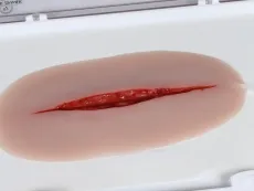 Wundmoulage Suizidversuch