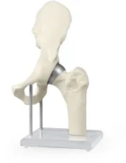 Hüftgelenk-Modell mit Schalenprothese