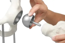 Hüftgelenk-Modell mit Schalenprothese