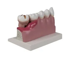 Dentalmodell, 4-fache Grösse