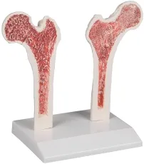 Osteoporose-Oberschenkel-Modell