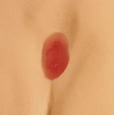 Druckgeschwür / Dekubitus Modelle