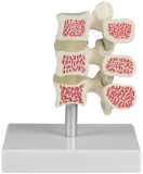 Osteoporose-Wirbel-Modell, 3 Wirbel