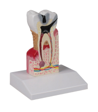 Zahnkariesmodell, 10-fache Grösse